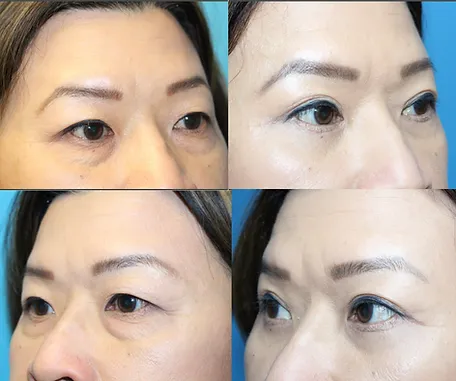 Eyelid Surgery with Rau Plastic Surgery — before & after result