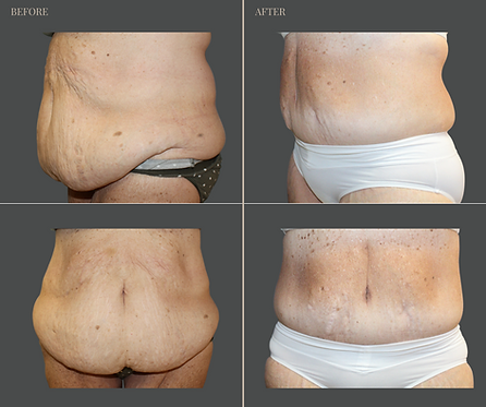 Tummy Tuck with Rau Plastic Surgery — before & after result