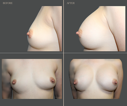 Breast Augmentation at Rau Plastic Surgery — before & after result