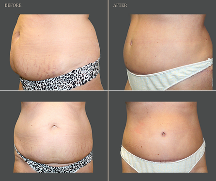 Tummy Tuck with Rau Plastic Surgery — before & after result