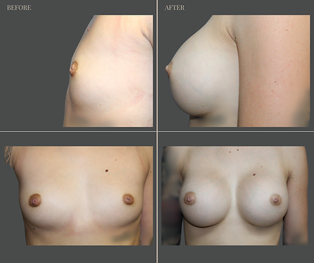 Breast Augmentation at Rau Plastic Surgery — before & after result