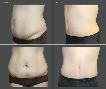 Tummy Tuck with Rau Plastic Surgery — before & after result