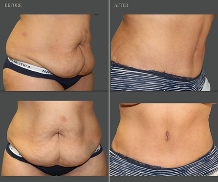 Tummy Tuck with Rau Plastic Surgery — before & after result