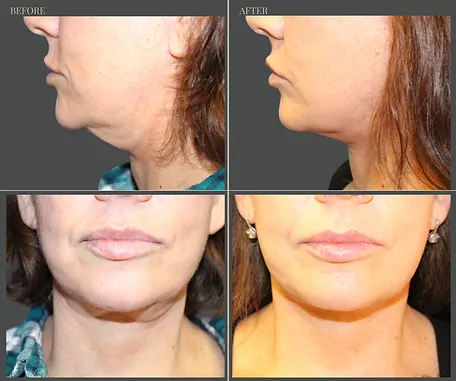 Natural — before & after result