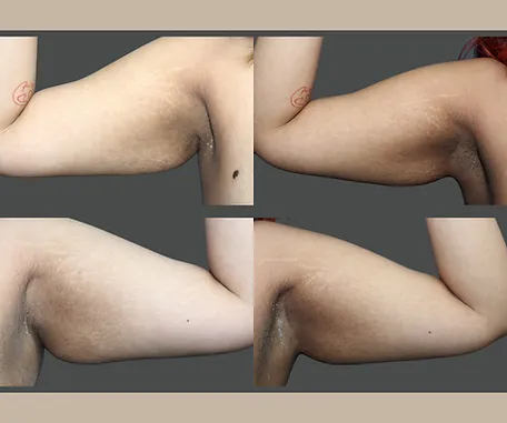 Get More Contoured Arms with Rau Plastic Surgery — before & after result