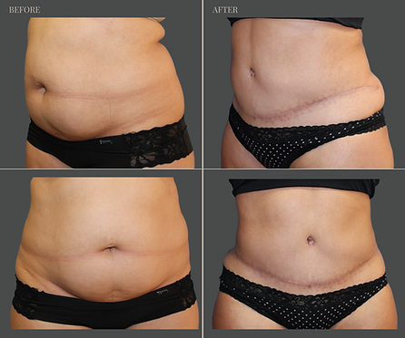Tummy Tuck with Rau Plastic Surgery — before & after result