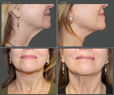 Natural — before & after result