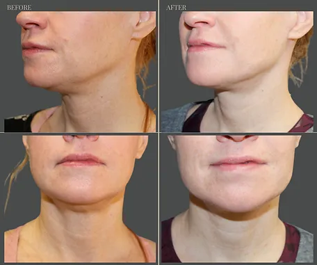 Natural — before & after result