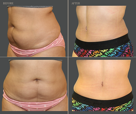 Tummy Tuck with Rau Plastic Surgery — before & after result