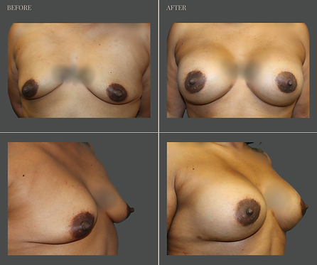 Breast Augmentation at Rau Plastic Surgery — before & after result