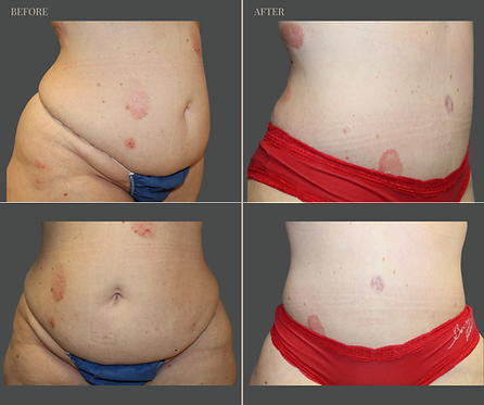 Tummy Tuck with Rau Plastic Surgery — before & after result