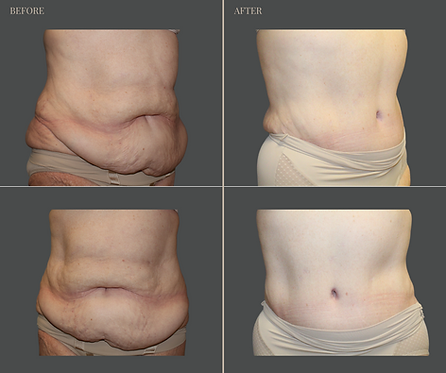 Tummy Tuck with Rau Plastic Surgery — before & after result