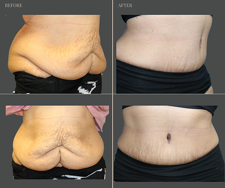 Tummy Tuck with Rau Plastic Surgery — before & after result