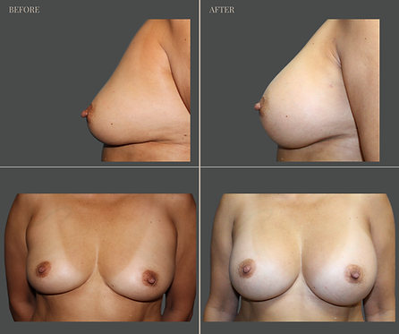 Breast Augmentation at Rau Plastic Surgery — before & after result