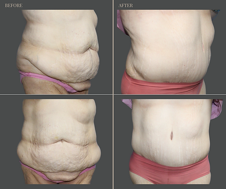 Tummy Tuck with Rau Plastic Surgery — before & after result