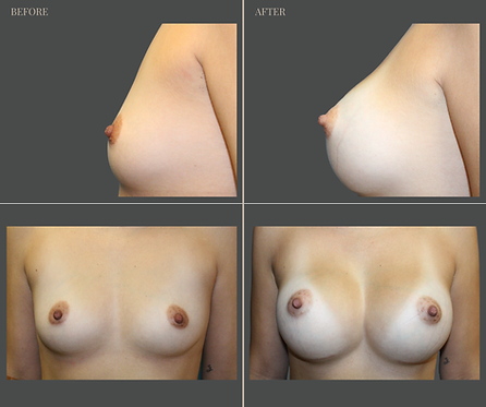 Breast Augmentation at Rau Plastic Surgery — before & after result