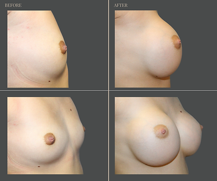 Breast Augmentation at Rau Plastic Surgery — before & after result