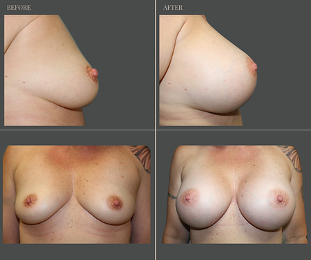 Breast Augmentation at Rau Plastic Surgery — before & after result