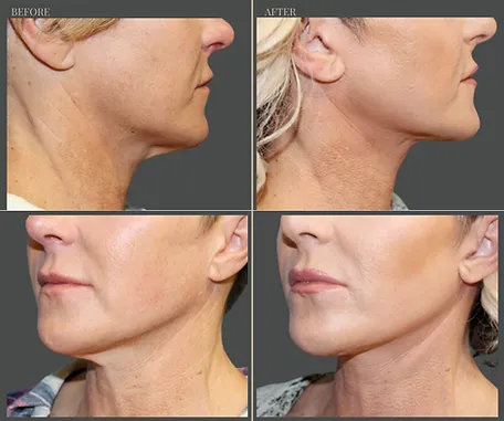 Natural — before & after result