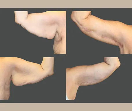 Get More Contoured Arms with Rau Plastic Surgery — before & after result