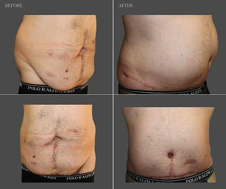 Tummy Tuck with Rau Plastic Surgery — before & after result