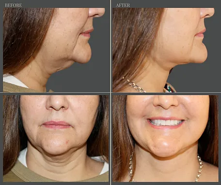 Natural — before & after result