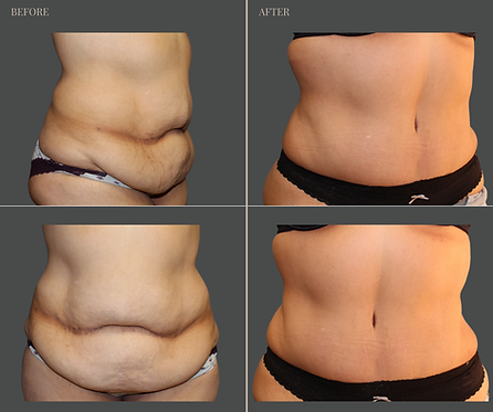 Tummy Tuck with Rau Plastic Surgery — before & after result