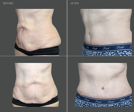 Tummy Tuck with Rau Plastic Surgery — before & after result