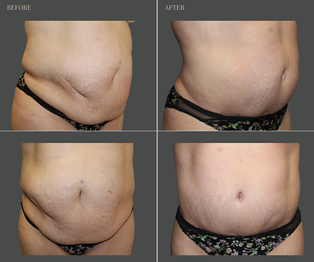 Tummy Tuck with Rau Plastic Surgery — before & after result