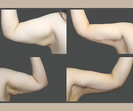 Get More Contoured Arms with Rau Plastic Surgery — before & after result