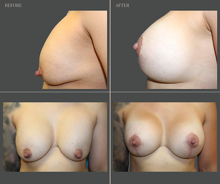 Breast Augmentation at Rau Plastic Surgery — before & after result