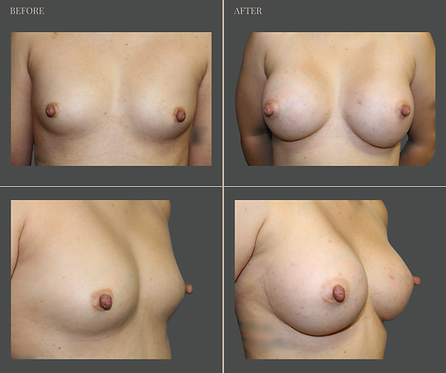 Breast Augmentation at Rau Plastic Surgery — before & after result