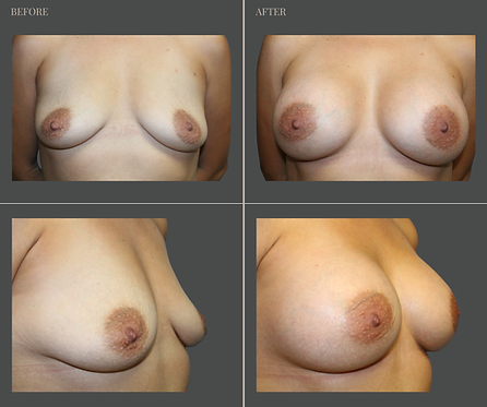 Breast Augmentation at Rau Plastic Surgery — before & after result
