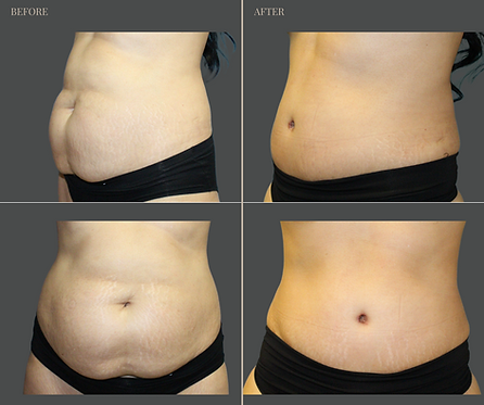Tummy Tuck with Rau Plastic Surgery — before & after result