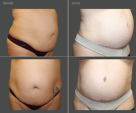 Tummy Tuck with Rau Plastic Surgery — before & after result