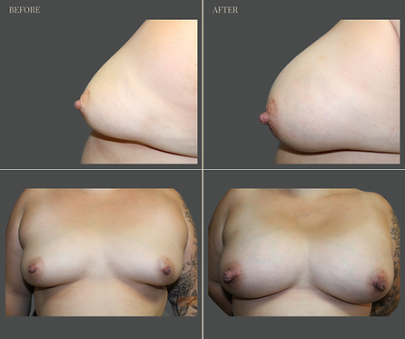 Breast Augmentation at Rau Plastic Surgery — before & after result
