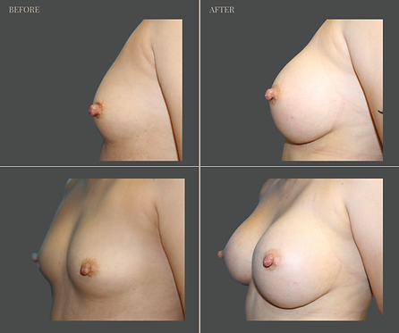 Breast Augmentation at Rau Plastic Surgery — before & after result
