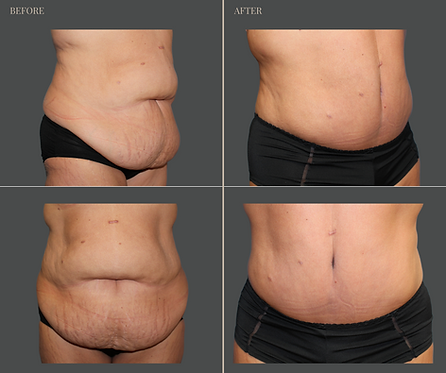 Tummy Tuck with Rau Plastic Surgery — before & after result