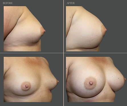 Breast Augmentation at Rau Plastic Surgery — before & after result