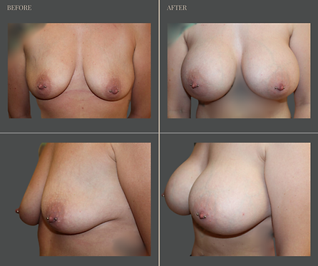 Breast Augmentation at Rau Plastic Surgery — before & after result