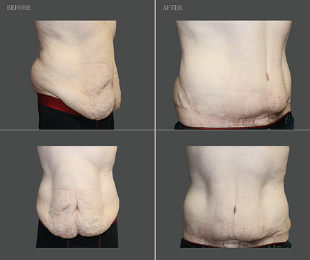 Tummy Tuck with Rau Plastic Surgery — before & after result