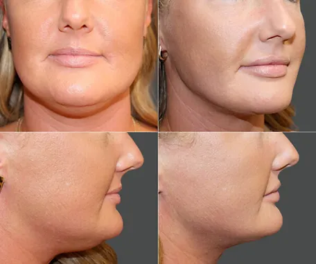 Liposuction of Face and Neck — before & after result