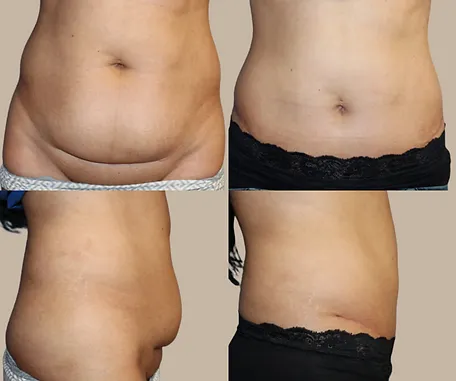 Mini Tummy Tuck with Rau Plastic Surgery — before & after result
