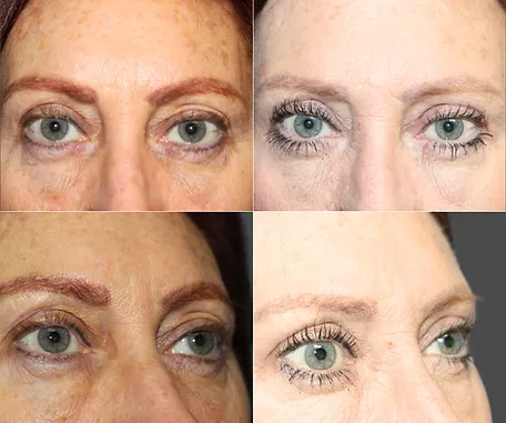 Eyelid Surgery with Rau Plastic Surgery — before & after result