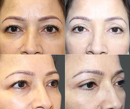 Eyelid Surgery with Rau Plastic Surgery — before & after result