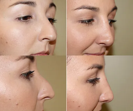 Rhinoplasty with Rau Plastic Surgery — before & after result