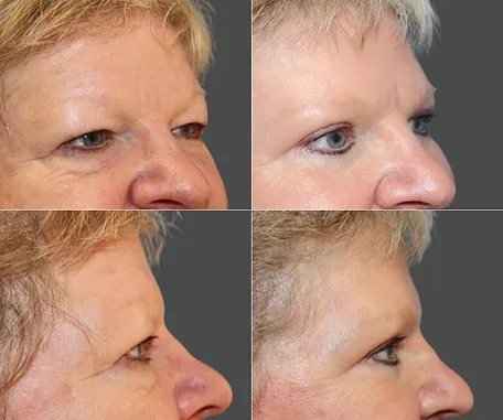 Eyelid Surgery with Rau Plastic Surgery — before & after result