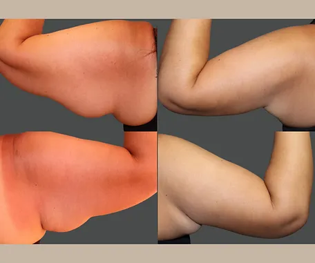Get More Contoured Arms with Rau Plastic Surgery — before & after result