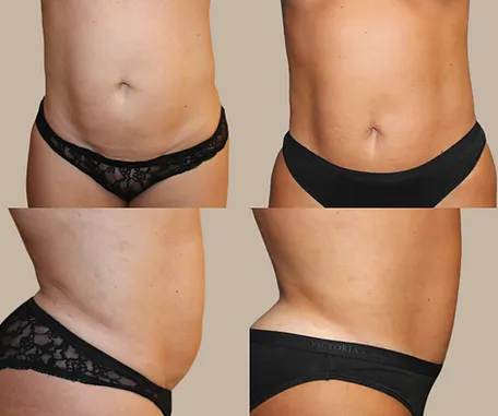 Mini Tummy Tuck with Rau Plastic Surgery — before & after result