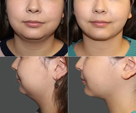 Liposuction of Face and Neck — before & after result